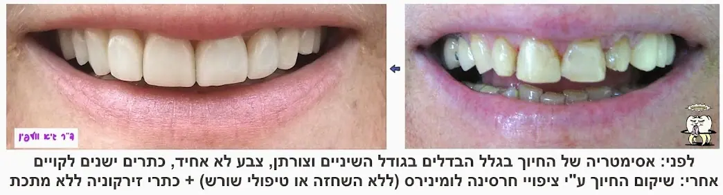 חיוך לאחר עיצוב שיניים בציפויי לומינירס וכתרי זירקוניה