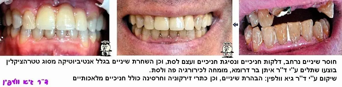 טיפול בשיניים שהוכהו עקב טטרציקלין בעזרת השתלות דנטליות וכתרי זירקוניה