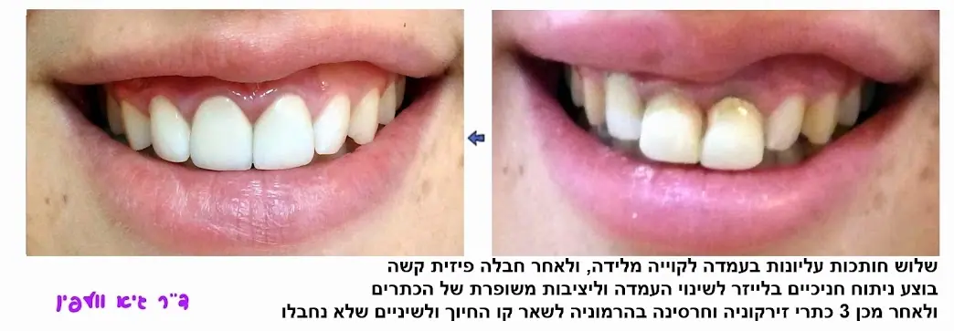מצב לפני ואחרי שיקום שלוש שיניים עליונות בכתרי זירקוניה וניתוח חניכיים בלייזר