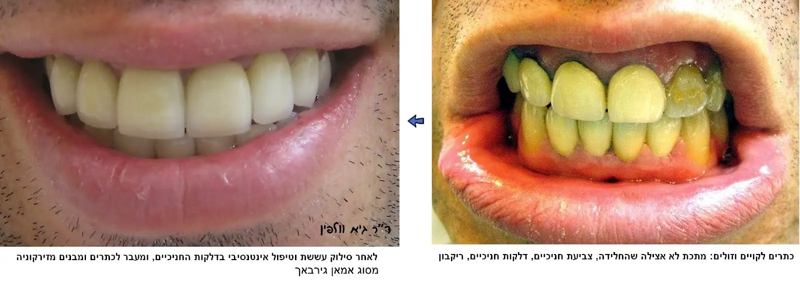 מצב לפני ואחרי שיקום הפה בכתרי זירקוניה - משיניים פגומות ומוזנחות לחיוך אחיד ולבן