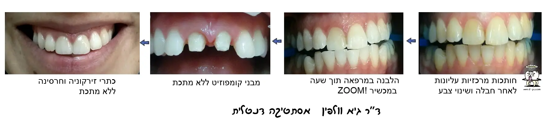 מצב לפני ואחרי שיקום החיוך בציפויי חרסינה לומינירס וכתרי זירקוניה ללא מתכת