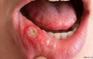 אפטה - פצע שורף בפה - גיא וולפין