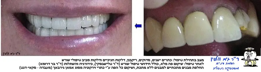 השוואה בין כתר זירקוניה לכתר מתכת וחרסינה, עם תמונת שן להמחשת ההבדל באיכות ובעמידות