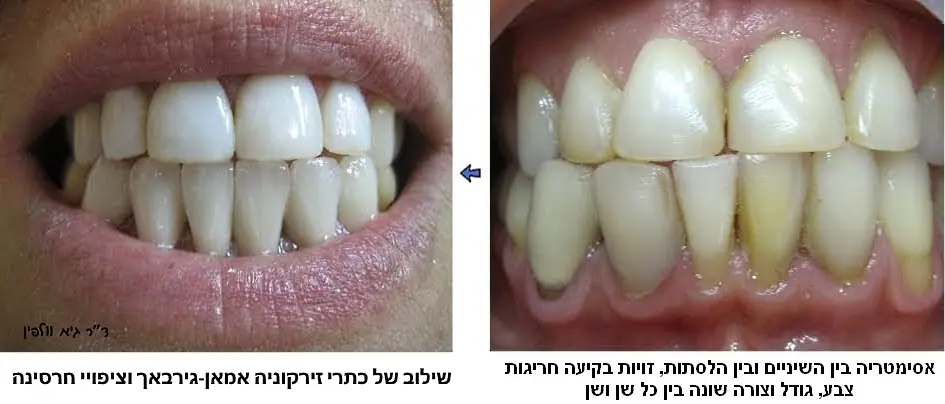 תיקון אסימטריה בין השיניים באמצעות שילוב כתרי זירקוניה וקומפוזיט