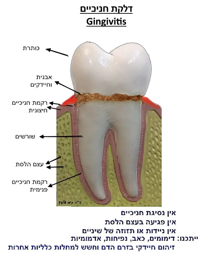 איור חתך שן עם סימון שלבי דלקת חניכיים (ג'ינג'יוויטיס) ותיאור התסמינים