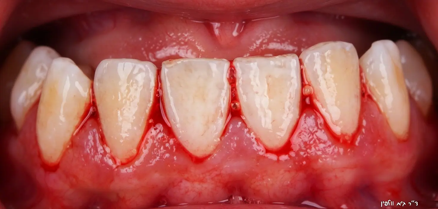 דלקת חניכיים - gingivitis - גיא וולפין - רופא שיניים מומלץ - פתח תקווה