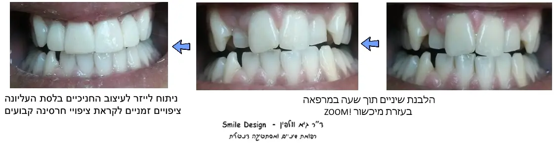 שיקום החיוך בלייזר ובכתרי זירקוניה וחרסינה - תוצאה סופית של חיוך לבן ואחיד