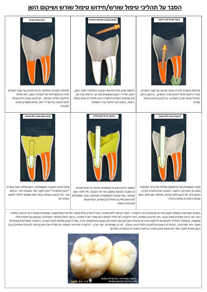 טיפול שורש או חידוש טיפול שורש ושיקום השן ללא מתכת
