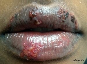 הרפס שפתיים זובירקס ותרופות סבתא, גיא וולפין