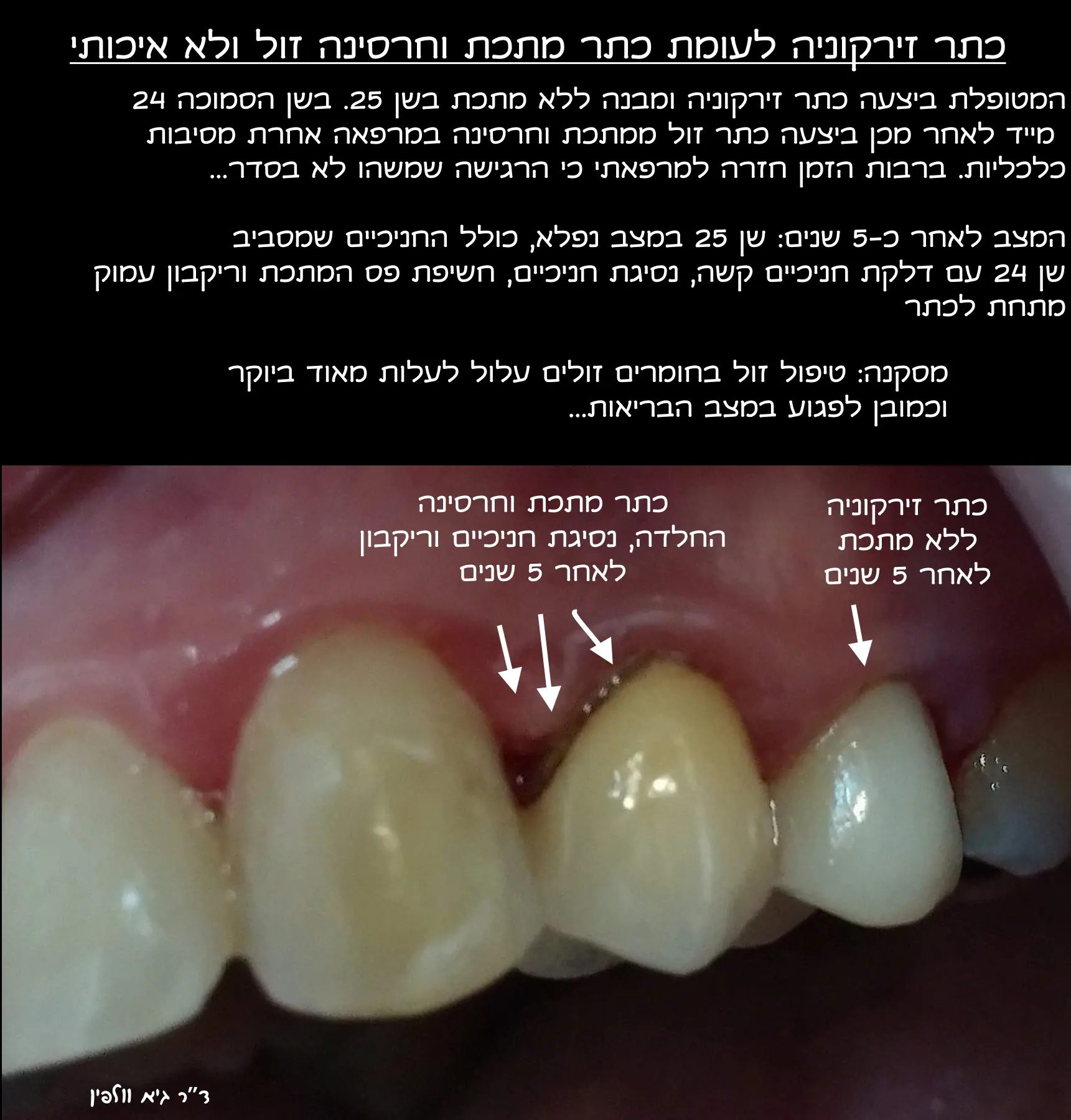שלבי הלבנת שיניים במרפאה במכשיר ZOOM וניתוח לייזר לעיצוב קו החניכיים העליון