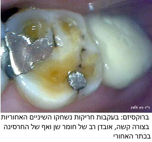 חריקה-ברוקסיזם-טוחנות-וולפין