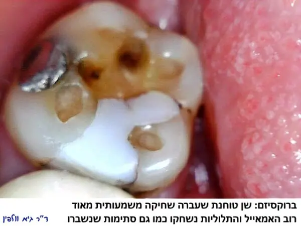 טוחנות--שיניים-שחיקה-חריקה-ברוקסיזם-600x450