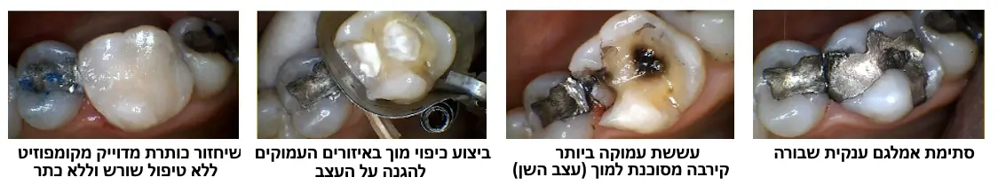 כיפוי מוך ושיחזור השן ללא כתר וללא טיפול שורש - ד"ר גיא וולפין
