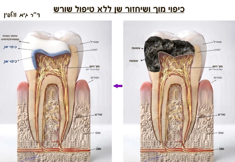 כיפוי מוך וקומפוזיט - להציל שן עם חור עמוק מטיפול שורש וכתר - ד"ר גיא וולפין