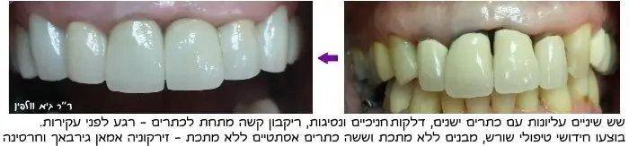 מצב השיניים לפני ואחרי תיקון אסימטריה בין השיניים בשיקום הפה