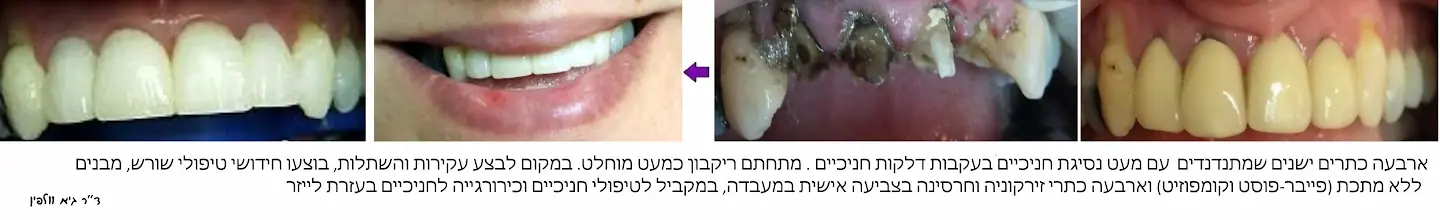 מצב השיניים לפני ואחרי טיפול המשלב כתרי זירקוניה וניתוח לייזר בחניכיים