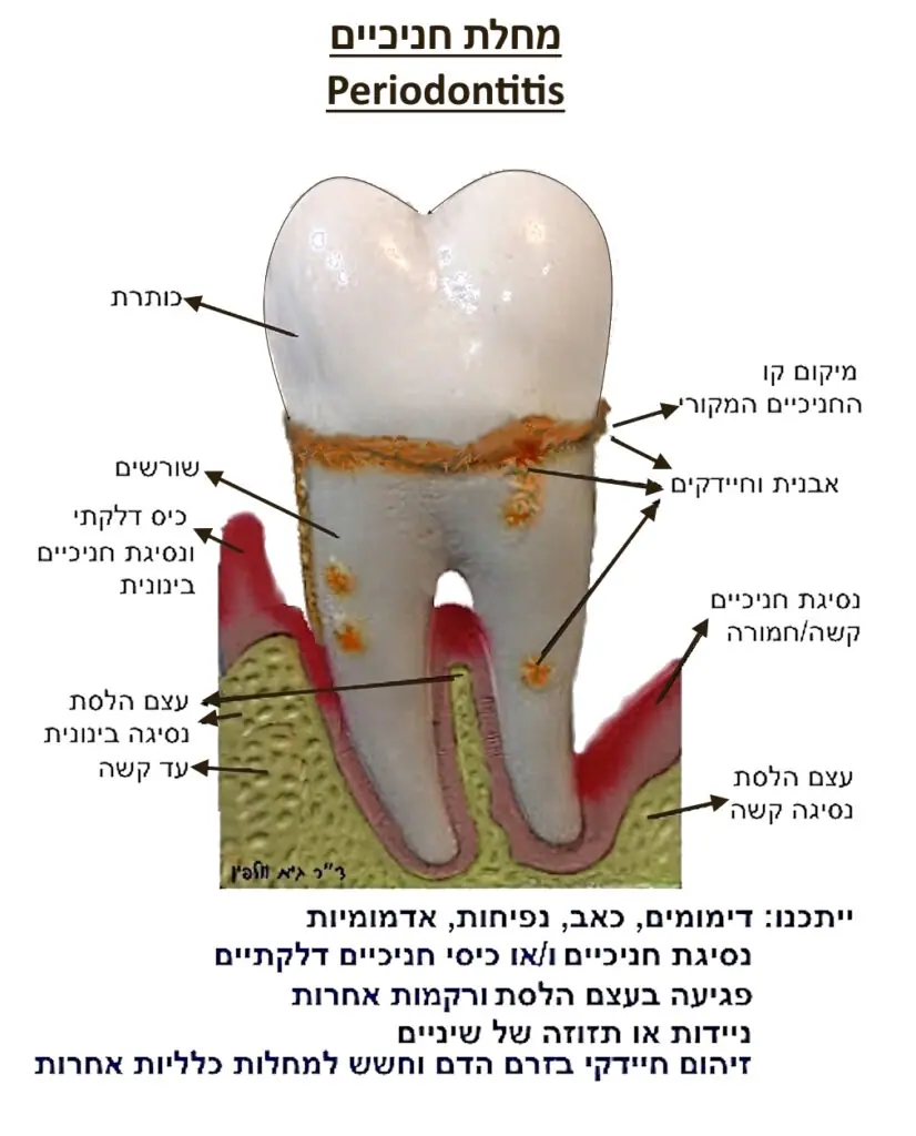 מחלת חניכיים - פריודנוטיטיס -periodontitis - גיא וולפין רופא שיניים מומלץ