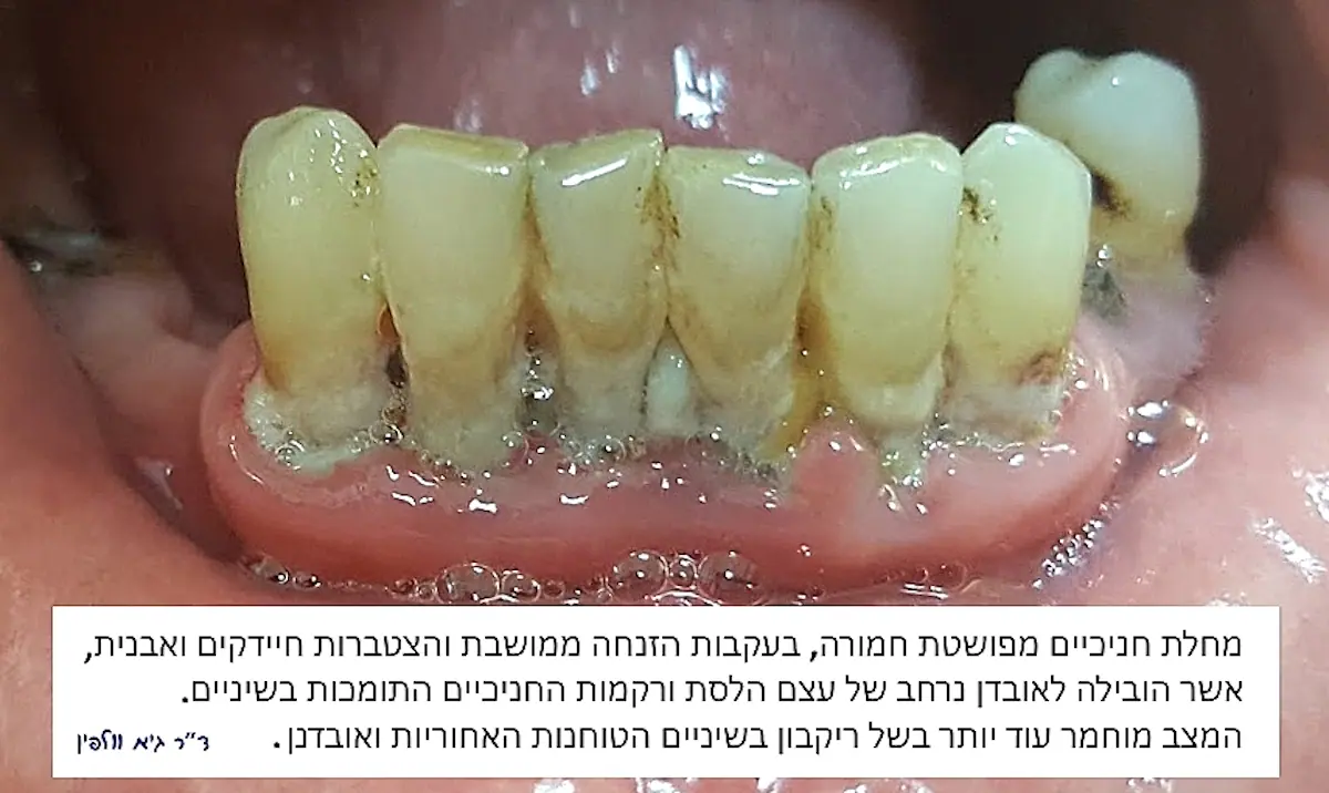 פריודונטיטיס אבנית מחלת חניכיים הזנחה נסיגת חניכיים אובדן יציבות - גיא וולפין - רופא שיניים מומלץ פ"ת