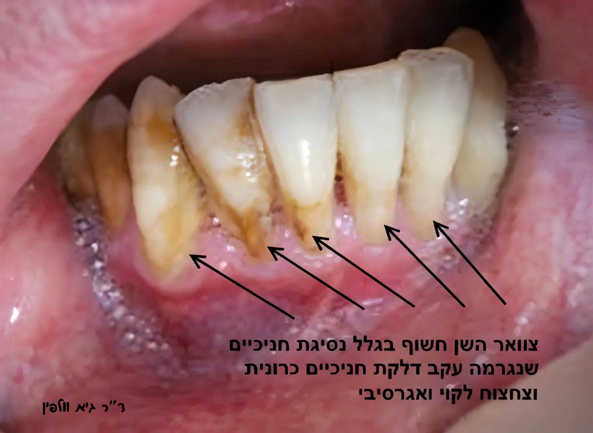 נסיגת חניכיים צחצוח אגרסיבי ודלקת גיא וולפין