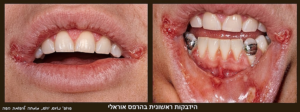 פרופ' נועם ירום - מומחה לרפואת הפה - ההדבקה-הראשונית-פרימארית-בהרפס-אוראלי-2