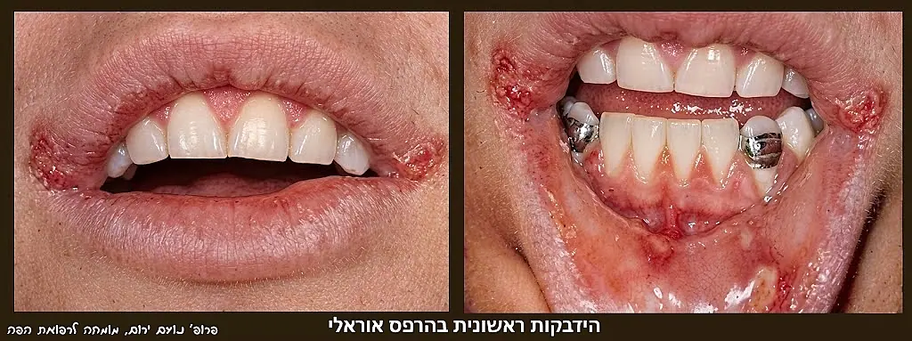 פרופ' נועם ירום - מומחה לרפואת הפה - ההדבקה-הראשונית-פרימארית-בהרפס-אוראלי-2