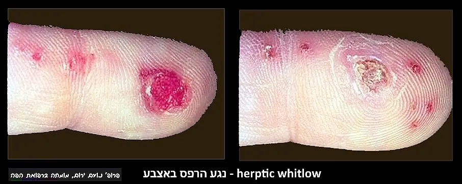 פרופ' נועם ירום - נגע-הרפס-אצבע-herpetic-whitlow-2