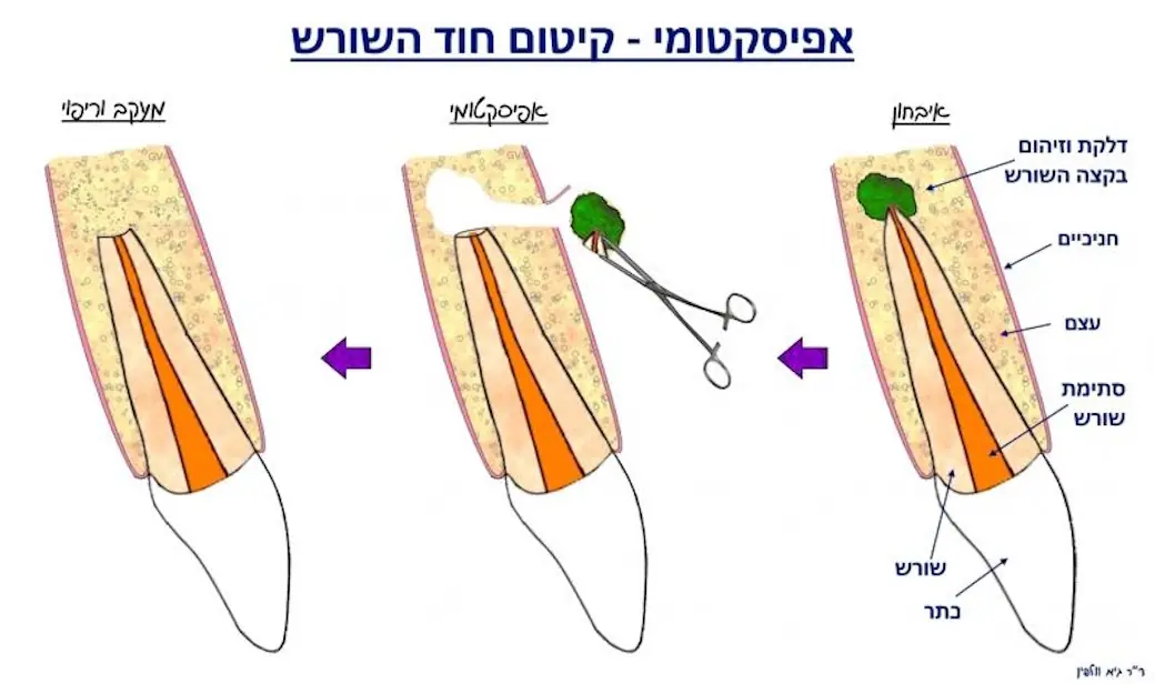 קיטום אנדודנטיה הסבר אפיסקטומי וולפין