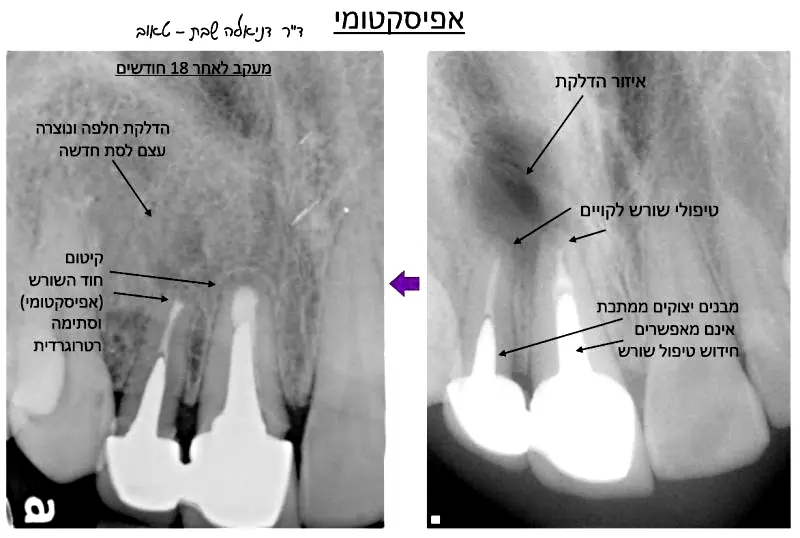 קיטום אנדודנטיה רנטגן אפיסקטומי וולפין
