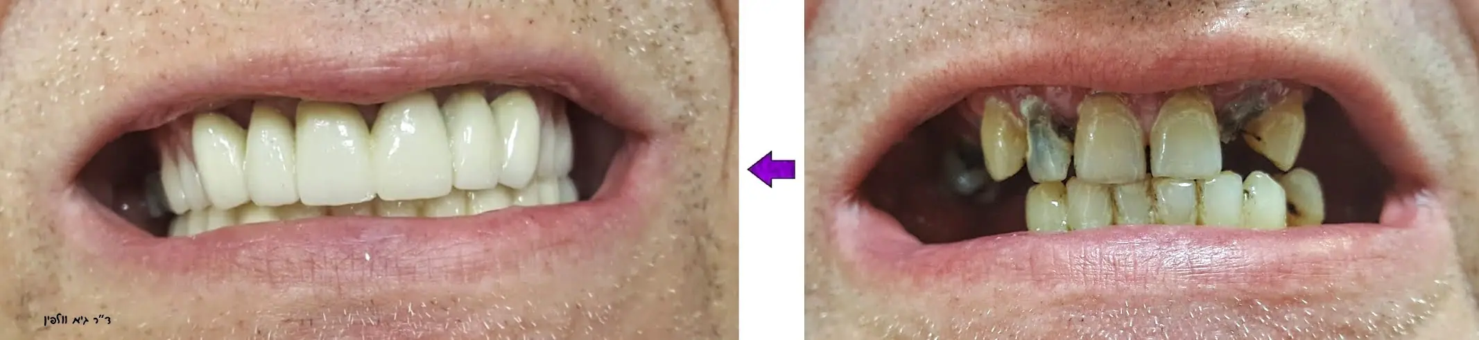מצב השיניים לפני ואחרי שיקום הפה באסתטיקה דנטלית