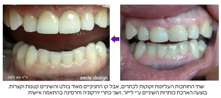 מצב לפני ואחרי החלפת שני כתרים בזירקוניה וחרסינה עם הארכת כותרת חניכיים בלייזר