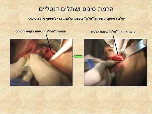 שלבי ניתוח הרמת סינוס: פתיחת חלון בעצם הלסת