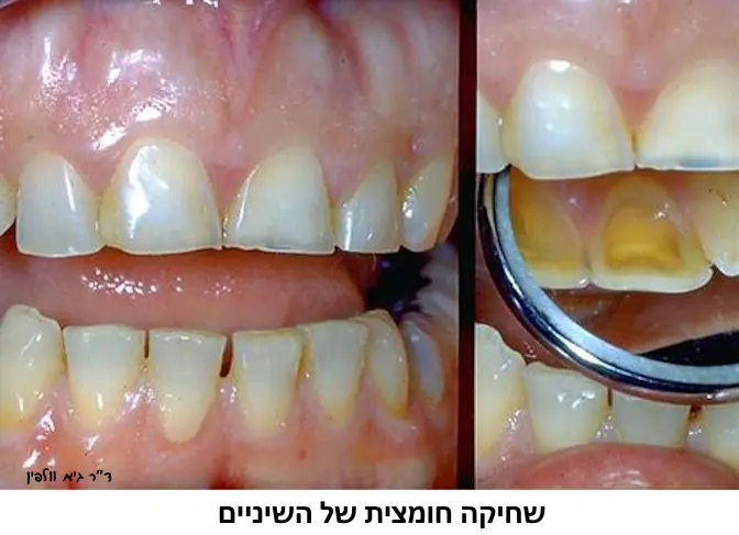 שחיקה חומצית של השיניים- גיא וולפין