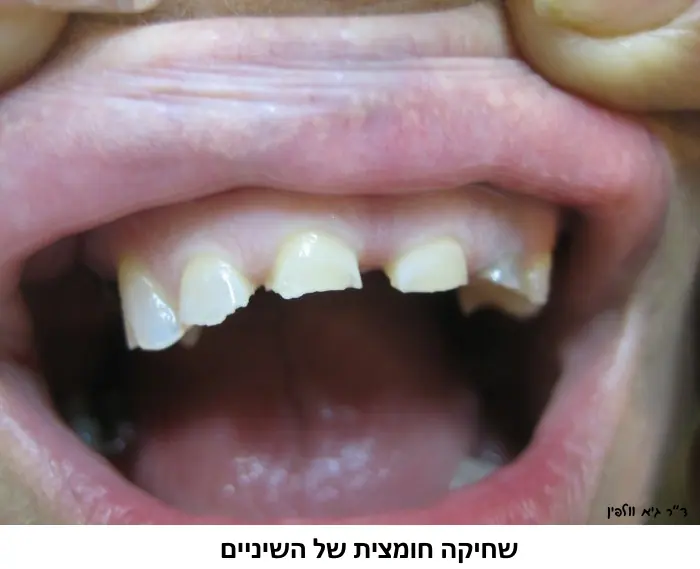 acid.erosion.volfin.1-1
