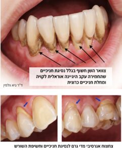 נסיגת חניכיים חשיפה צוואר השן חשיפת שורש רגישות וכאב צחצוח אגרסיבי מחלת חניכיים רפואת חניכיים פתח תקווה ד"ר גיא וולפין