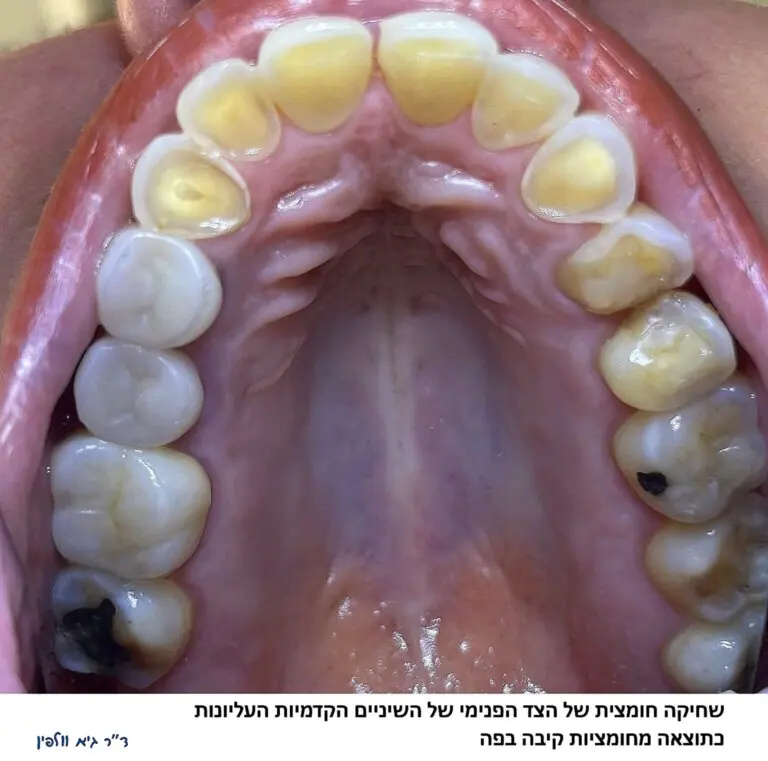 שחיקה חומצית של השיניים- גיא וולפין