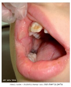 אפטה עששת צליאק - בריאות הפה תוך כדי מחלת הצליאק