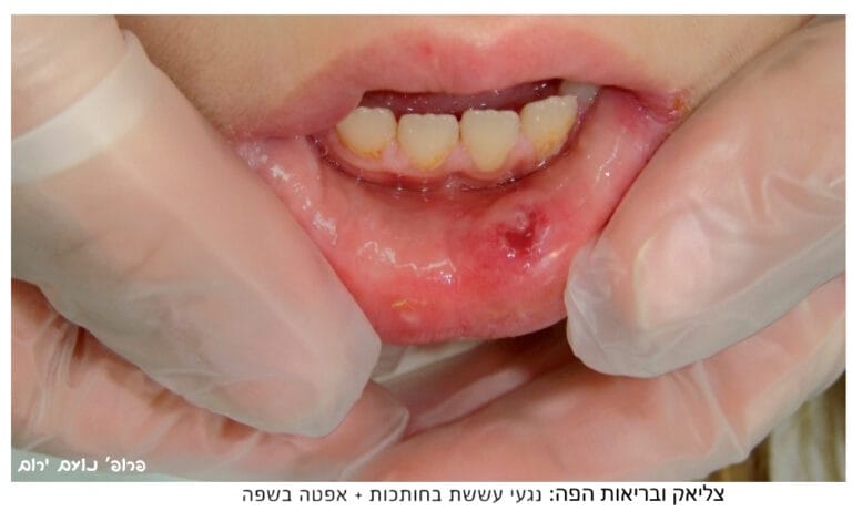 אפטה עששת צליאק - בריאות הפה תוך כדי מחלת הצליאק